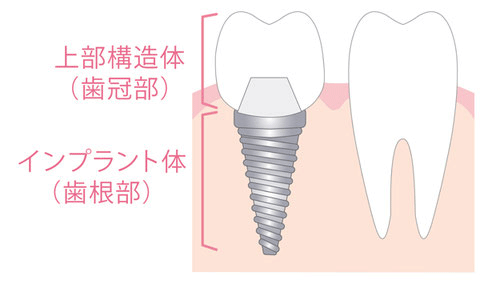手術用マウスピースで安全にインプラントを埋入