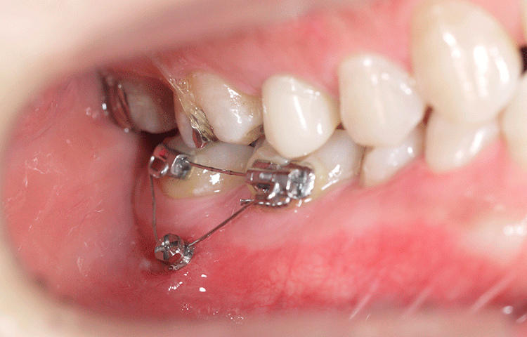 矯正用インプラント