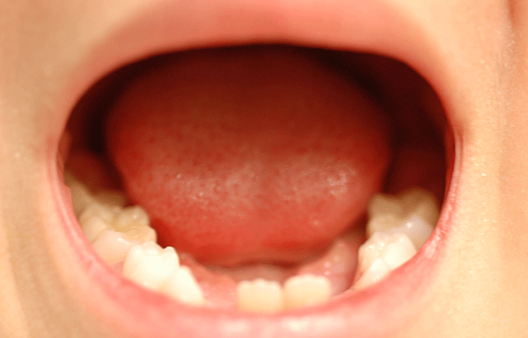 乳歯は歯垢がたまりやすい